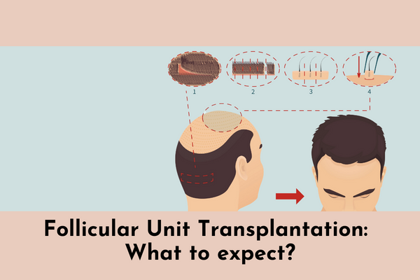 Follicular Unit Transplantation: What to Expect?