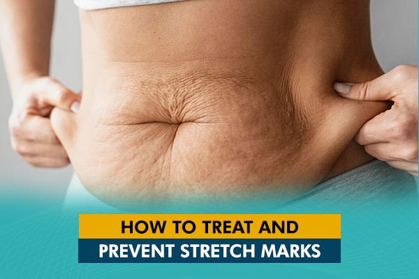 How to Treat and Prevent Stretch Marks?