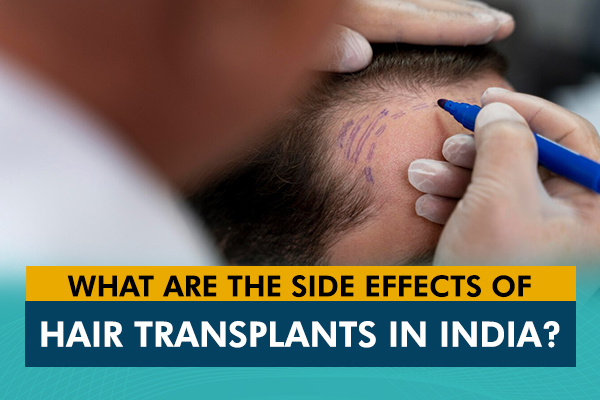 What Are the Side Effects of Hair Transplants in India?
