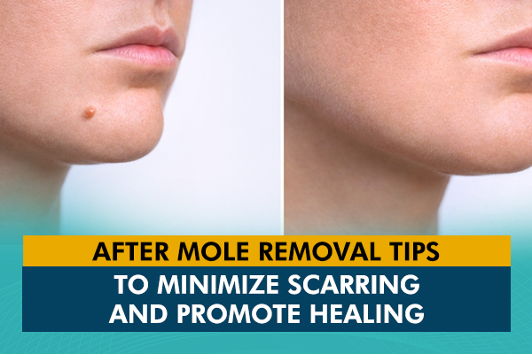 7 Tips to Heal Quickly After Mole Removal Procedure