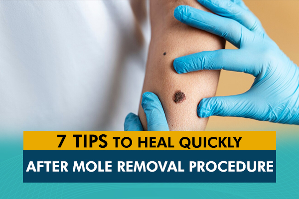 7 Tips to Heal Quickly After Mole Removal Procedure