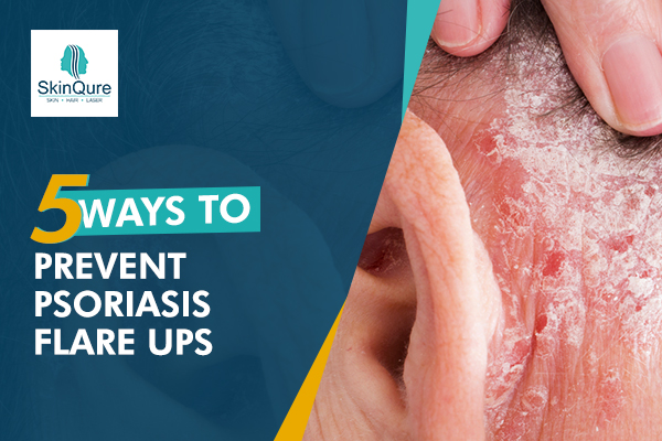 5 Ways to Prevent Psoriasis Flare ups