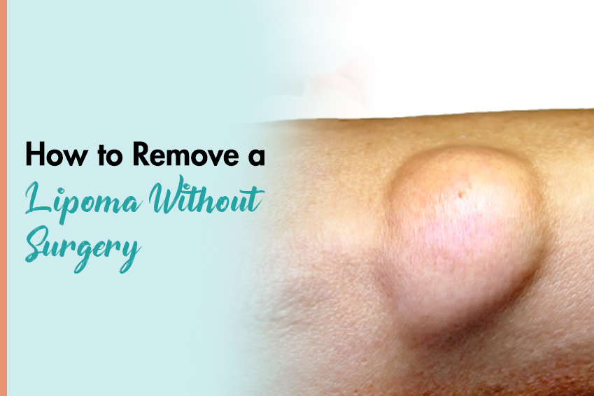 How to Remove a Lipoma Without Surgery?