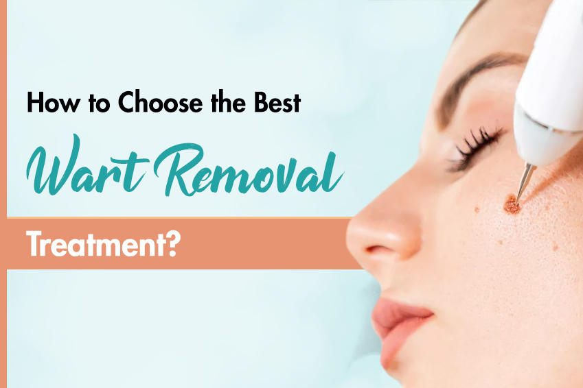 How to Choose the Best Wart Removal Treatment?