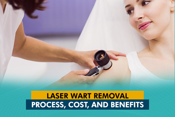 Laser Wart Removal: Process, Cost, and Benefits