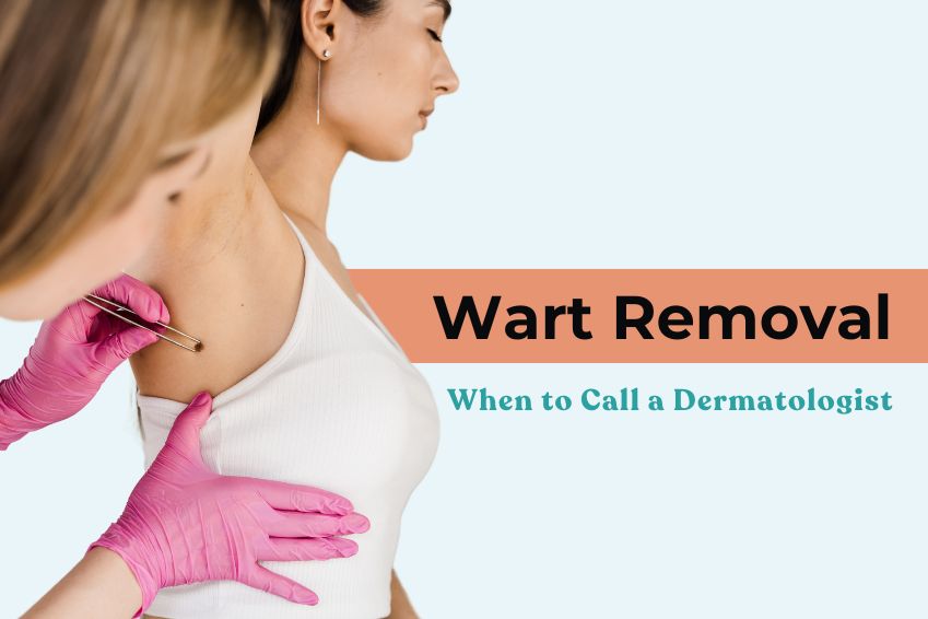Wart Removal: When to Call a Dermatologist