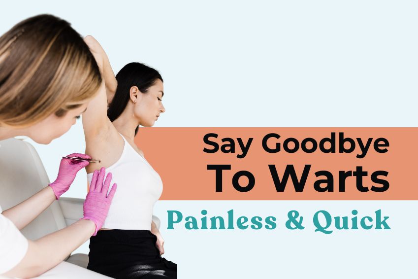 Say Goodbye to Warts – Painless & Quick