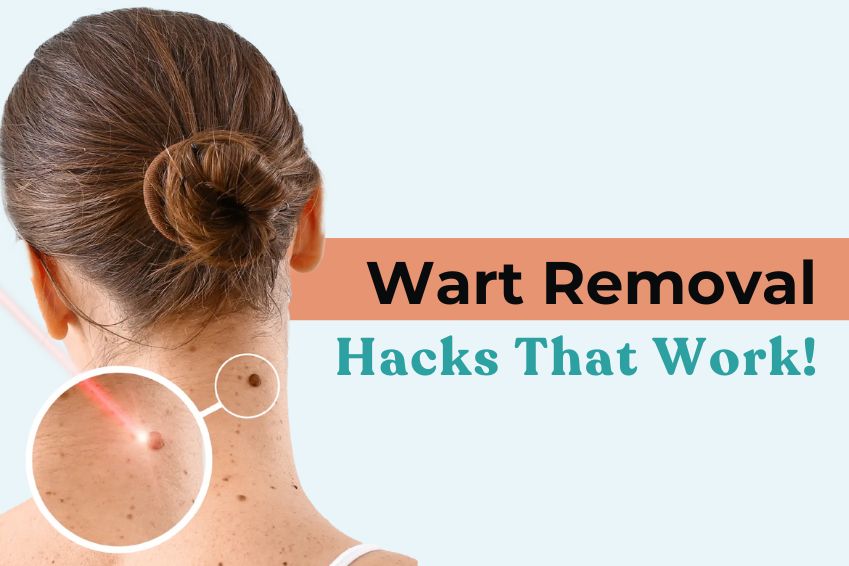 Warts Removal Hacks That Work!