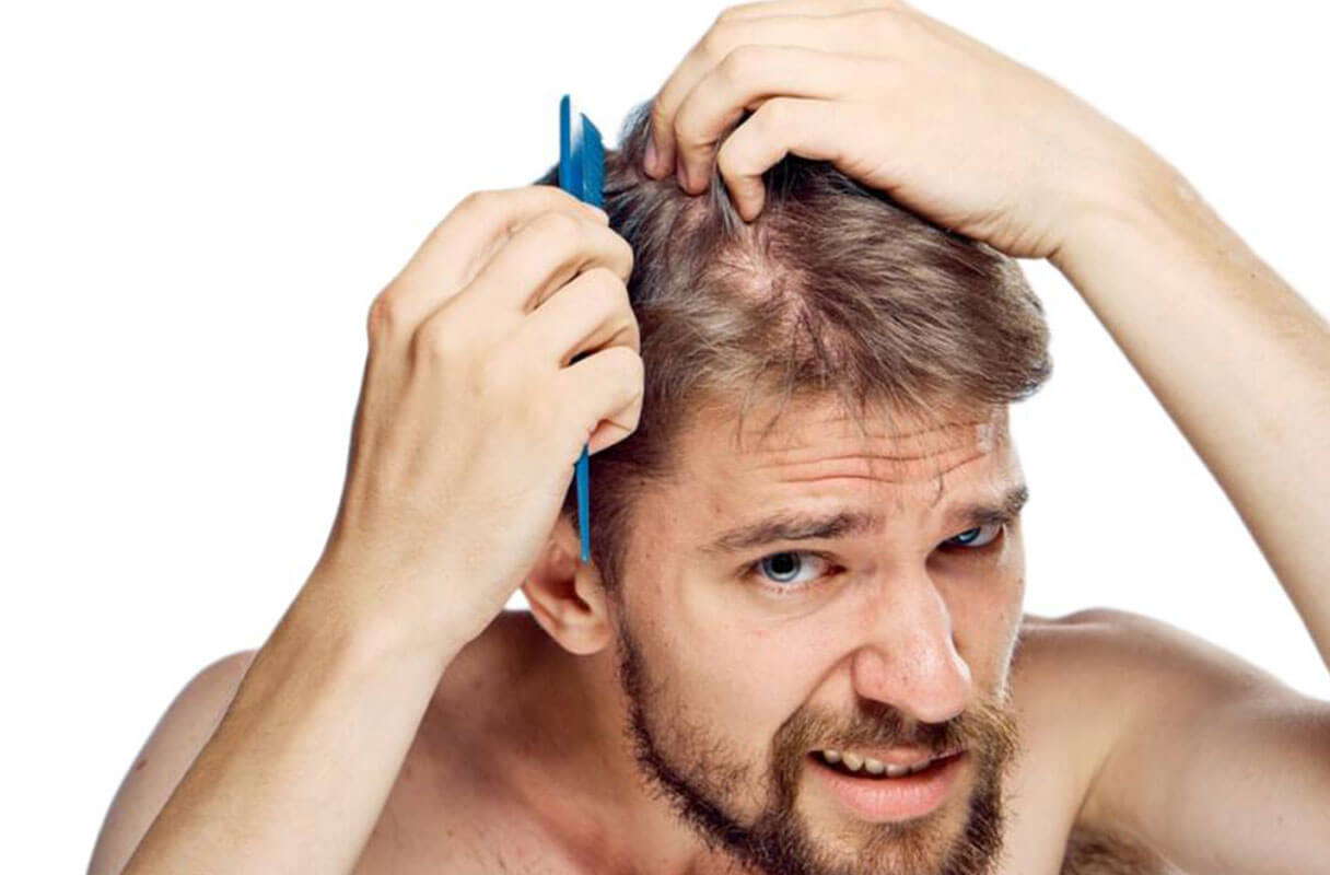 Ways to Remove Scabs After Hair Transplant