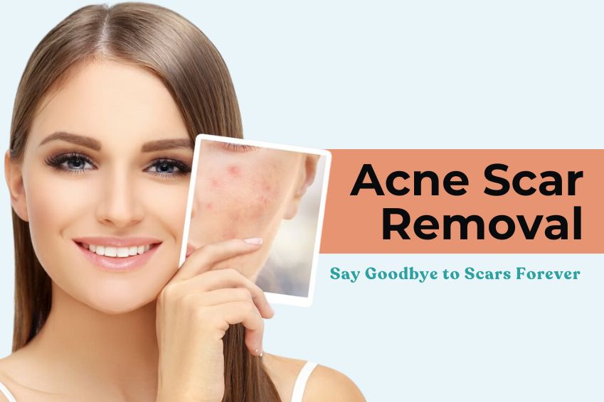 Acne Scar Removal: Say Goodbye to Scars Forever