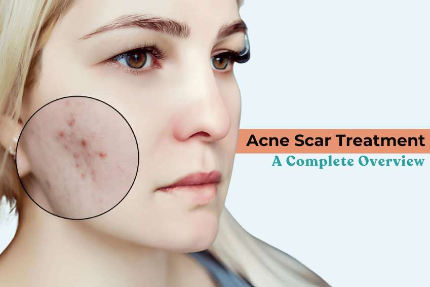 Acne Scar Treatment Cost in Delhi: An Overview