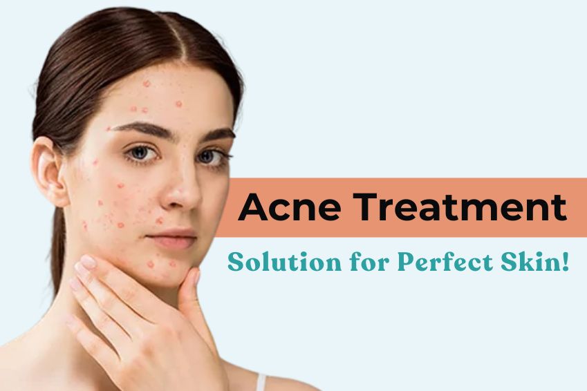 Acne Treatment Solution for Perfect Skin!