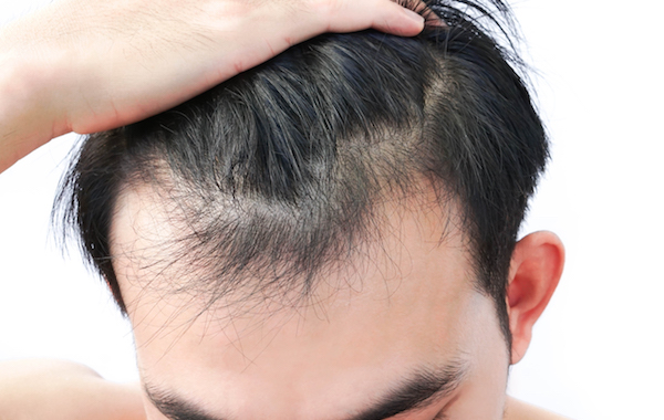 An Overview on Hair Thinning: Causes and Cure by Hair Specialist