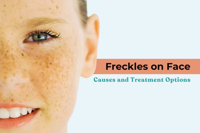 Freckles on Face: Causes and Treatment Options