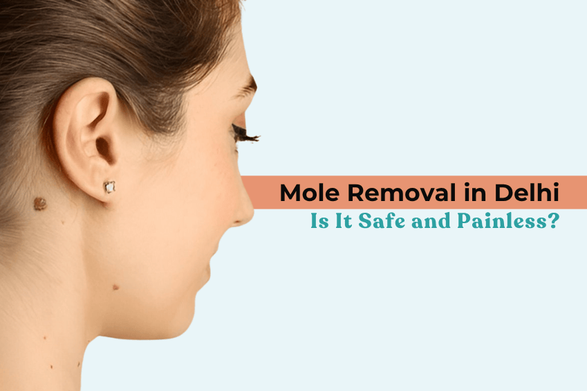 Mole Removal in Delhi: Is It Safe and Painless?