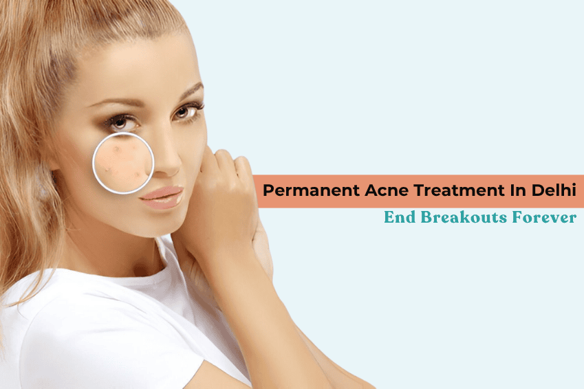 Permanent Acne Treatment In Delhi: End Breakouts Forever