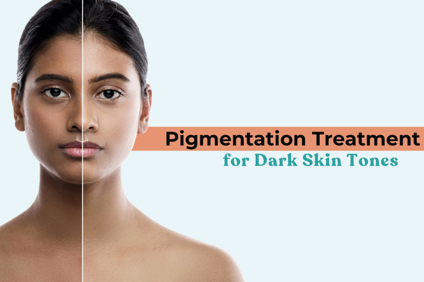 Pigmentation Treatment in Delhi for Dark Skin Tones