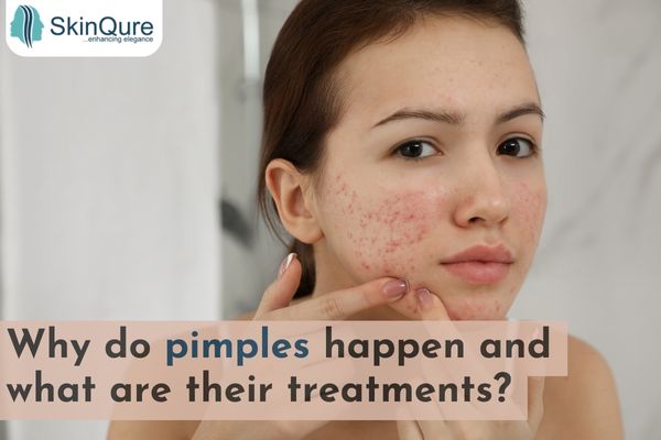 Why do pimples happen and what are their treatment?