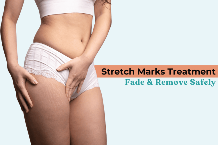 Stretch Marks Treatment: Fade & Remove Safely