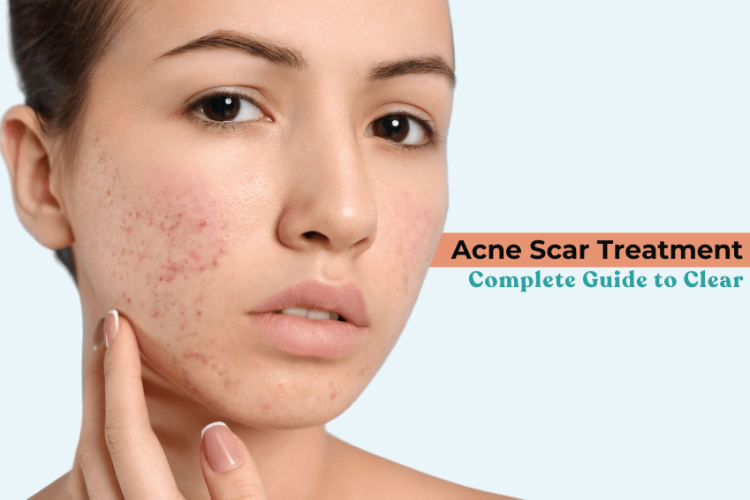 Acne Scar Treatment: Complete Guide to Clear