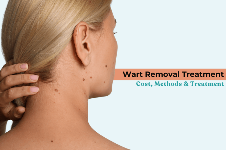 Wart Removal Treatment: Cost, Methods & Treatment