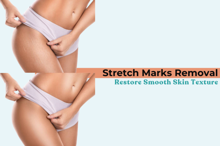Stretch Marks Removal: Restore Smooth Skin Texture