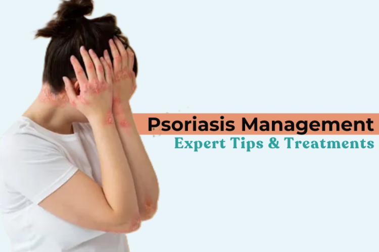 Psoriasis Management: Expert Tips & Treatments