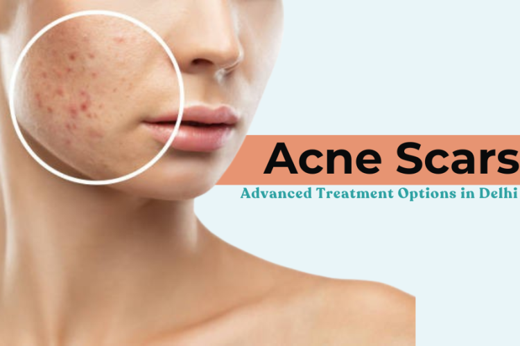 Acne Scars: Advanced Treatment Options in Delhi