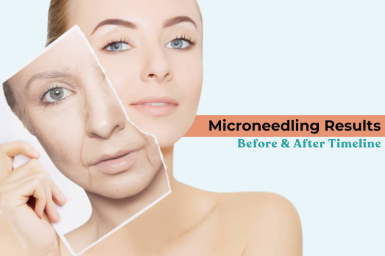 Microneedling Results: Before & After Timeline