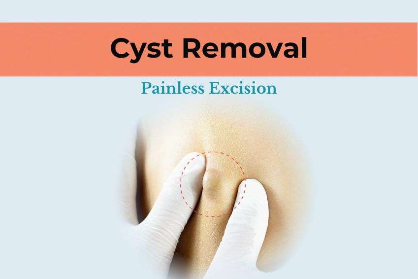Cyst Removal Treatment in Delhi: Painless Excision