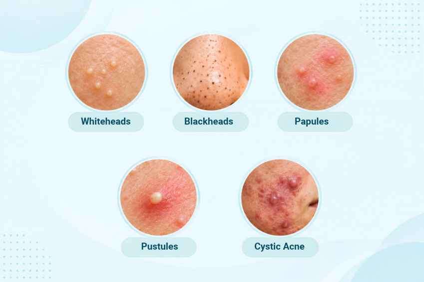 Teenage acne on facial skin