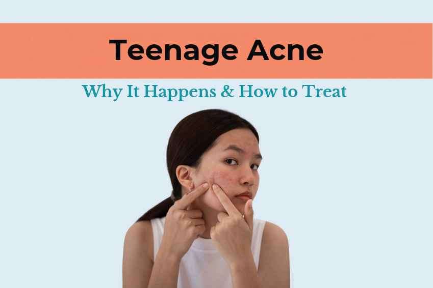 Teenage Acne: Why It Happens & How to Treat